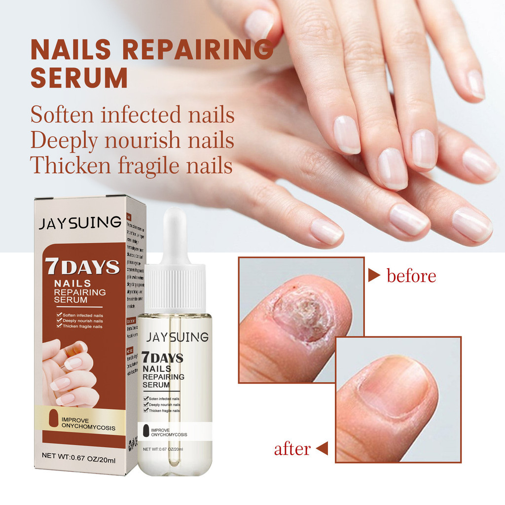 Jaysuing 7 Days Nail Repair Essence Repair เล็บคุดหนา Onychomycosis Hand Foot Nail Repair Lotion9820