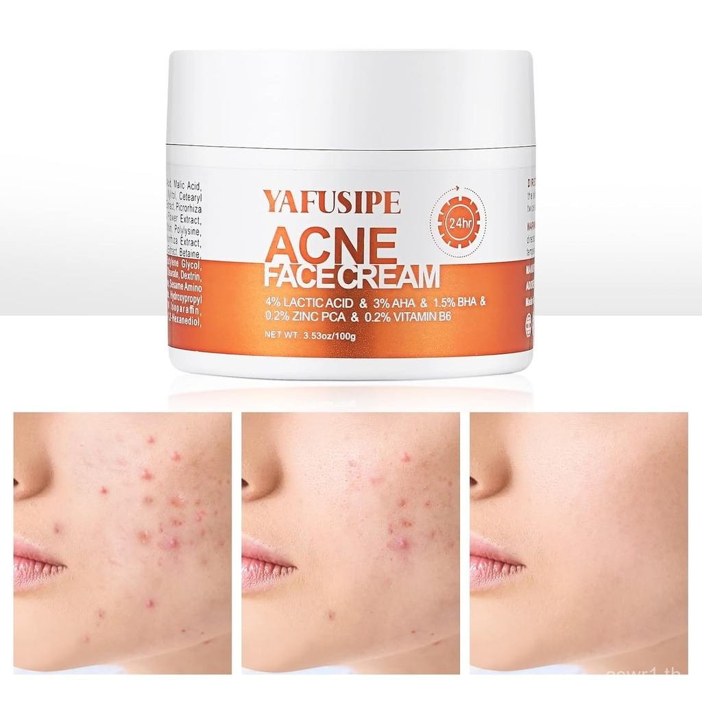 AcneTreatmentforFaceforฮอร์โมนCysticStubornAcneforSensitiveSkinTeensAdultsWomenMenSpotPimppleButtCon