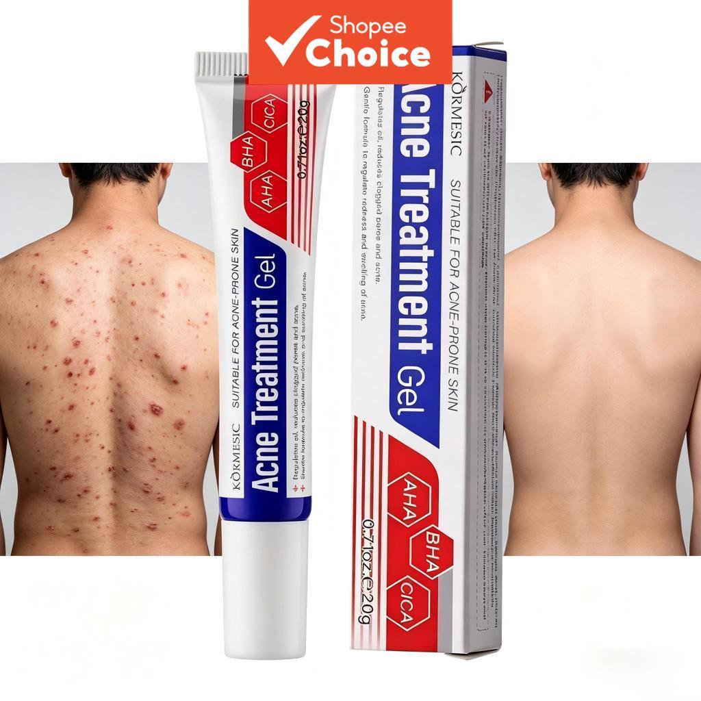 เจลรักษาสิว AHA BHA Cica Acne Spot , Pore Minimizing Acne Cream for Acne-Prone Skin, 20g
