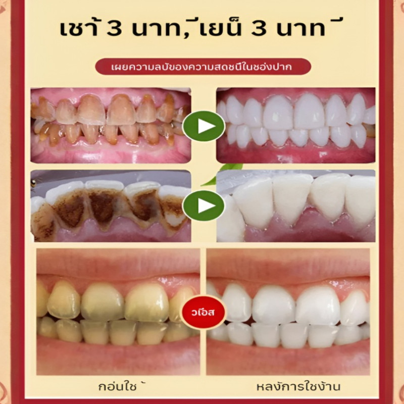 ฟอกฟัน ยาสีฟัน ยาสีฟันโปรไบโอติก SP10 ยาสีฟันทำความสะอาดและขจัดคราบ Whitening Toothpaste - รูปที่ 2
