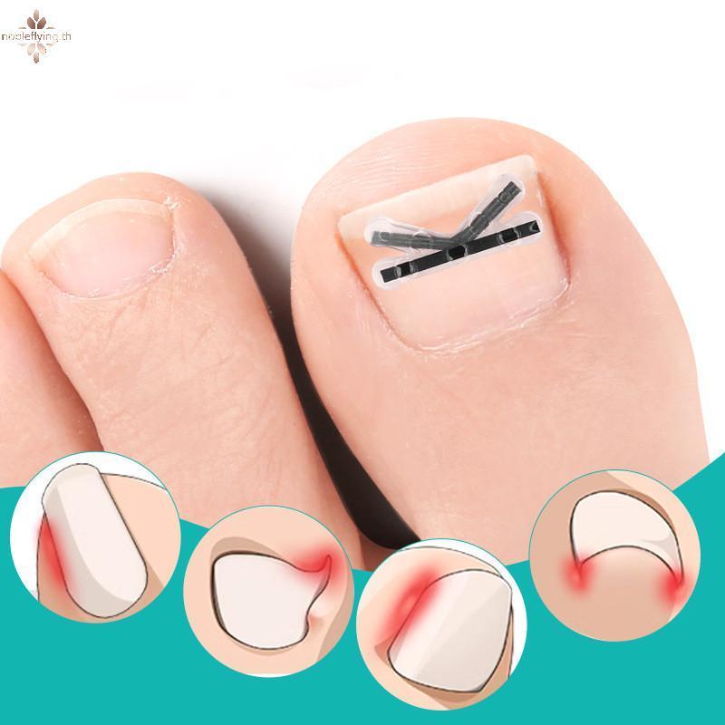 Nf 2 ชิ้นคุด Toenail Corrector Pedicure กู้คืน Embed Toe Nail Treatment Professional คุด Toenail Cor
