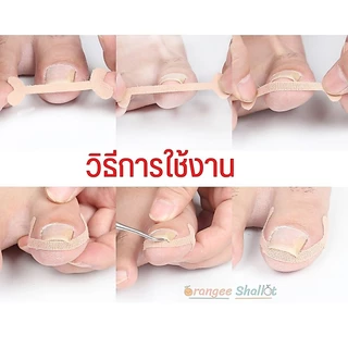 สติ๊กเกอร์เล็บขบ งุ้ม ม้วน เทปแปะกันเล็บขบเนื้อ แผ่นแปะเล็บขบ เล็บฝังลึกนิ้วเท้า 1ชุด มี4ชิ้น พร้อมส่ง