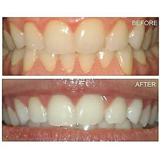🇺🇸🔥ปรึกษาได้ แผ่นฟอกฟัน Crest 3D Whitestrips Luxe Professional Effects ของแท้จาก USA + ยาสีฟัน ฟันขาว