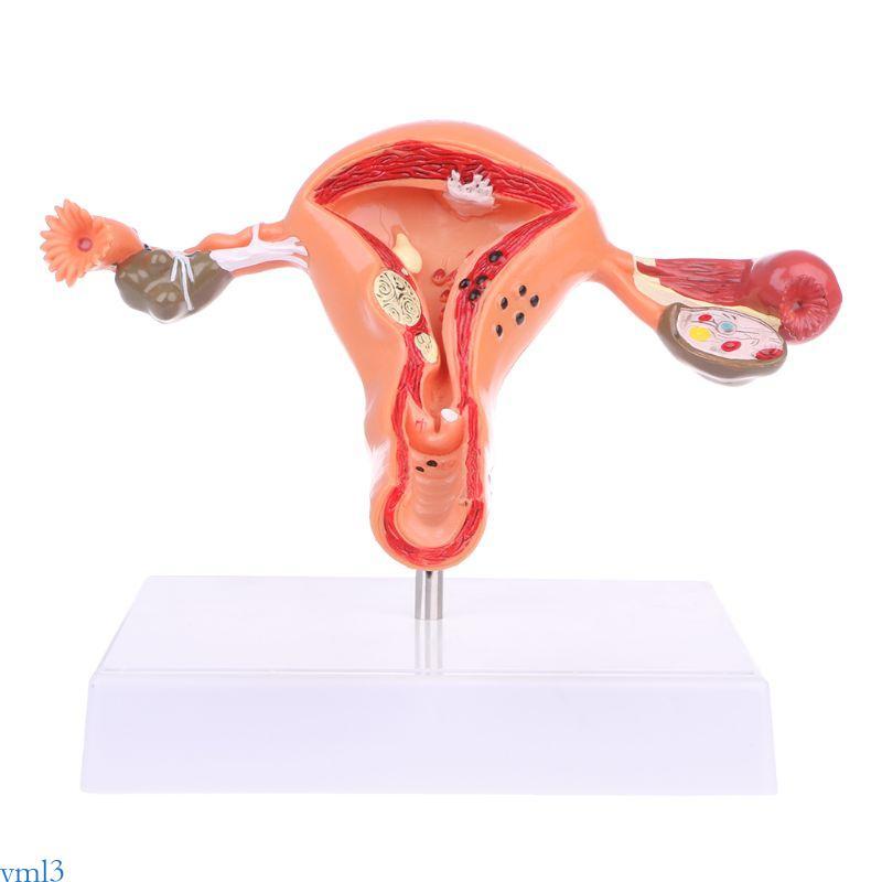 Yml3 มดลูกทางพยาธิวิทยา Ovary Anatomical รุ่น Anatomy สําหรับเครื่องมือศึกษาส่วนข้าม
