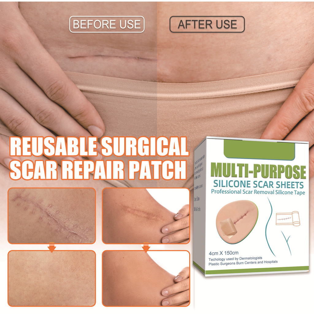 ✈จัดส่งในพื้นที่✈ ซิลิโคนเจลแถบแพทช์ซิลิโคนแผลเป็นแผ่นนํามาใช้ใหม่ซิลิโคนแผลเป็นกําจัดแพทช์ลบ ทูมา เผาแผลเป็นแผ่นซ่อมแซมผิวกําจัดรอยแผลเป็นแพทช์บําบัด