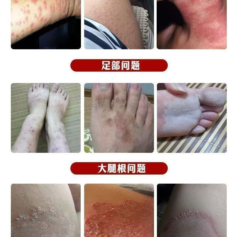 New Product#APDMP Yunnan Fungus King external use cream for skin itching, dry and itchy hands and fe