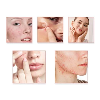 แผ่นแปะสิวรูปดาวสีสันสดใส Hydrocolloid Acne Cover Blemish Care ดูดซับอ่อนโยน 600 ชิ้น