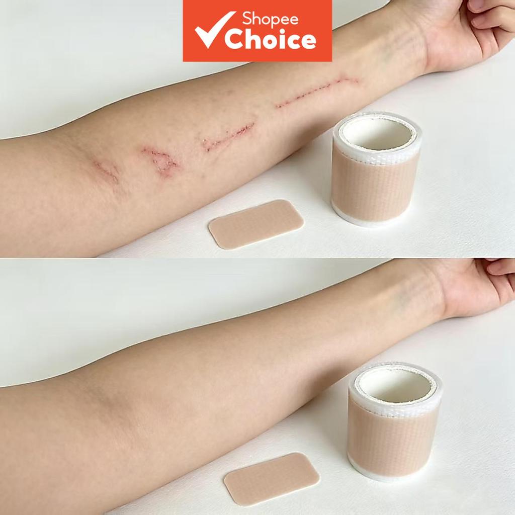 แผ่นซิลิโคนอ่อนนุ่มสําหรับสมานแผลผ่าตัด ลดรอยแดง แผ่นปิดแผลแบบกาวในตัว