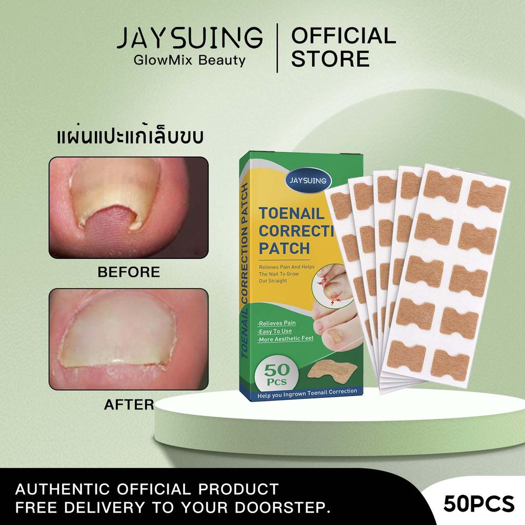 Jaysuing แผ่นแก้เล็บขบ เล็บคุด ปรับรูปเล็บเท้า ไม่ต้องผ่าตัด กันน้ำ ใช้ซ้ำได้ 50ชิ้น