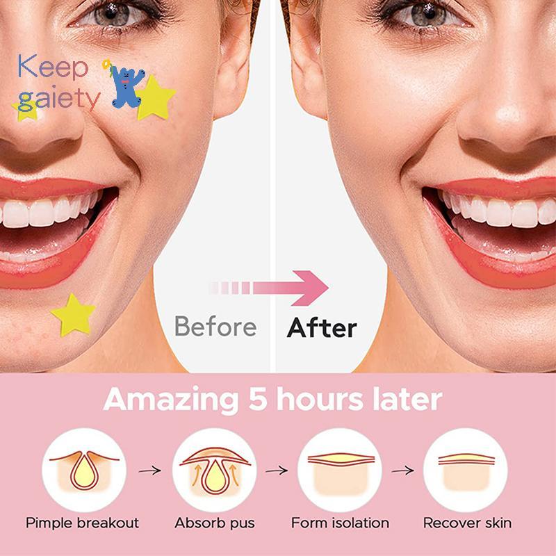 [Kpt-t] 456 ชิ้นที่มีสีสัน Star Pimple Patch สิวที่มีสีสันที่มองไม่เห็น Skin Care Stiers คอนซีลเลอร์