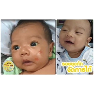 [โปร 2 ชิ้น] บาล์มลดคัน ลดบวม ไม่ทิ้งรอยดำ Chicky Mild บาล์มทายุงกัด มด แมลง ผื่นแพ้ ทาหน้าได้