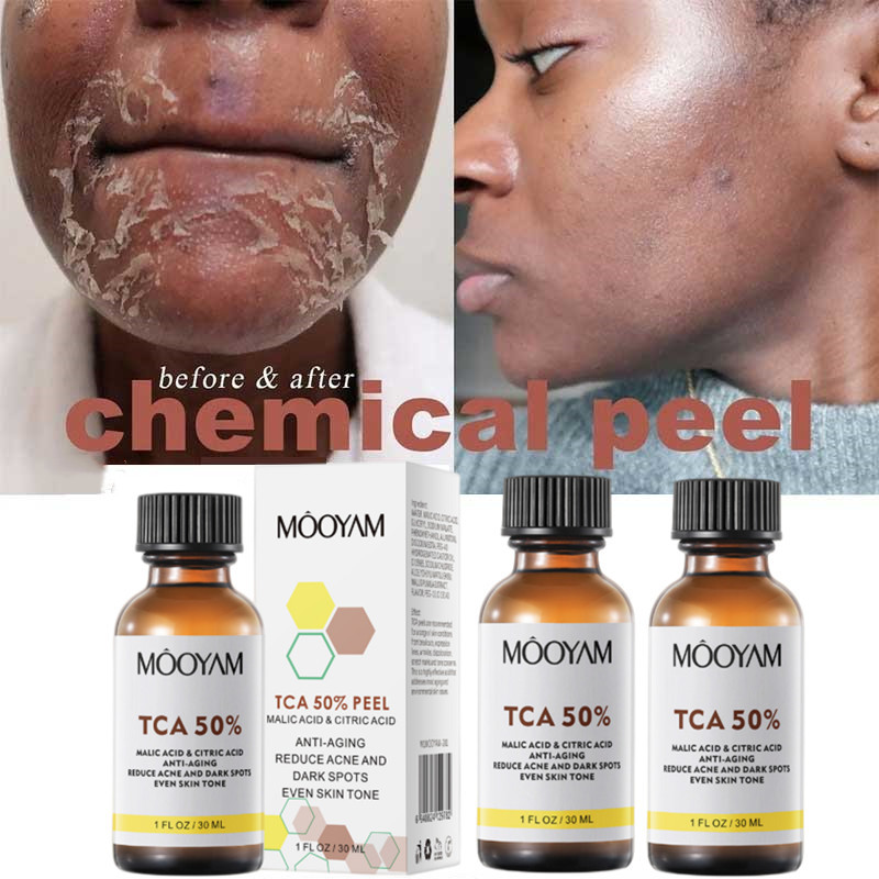 ส่วนลดเอ็กซ์คลูซีฟ Tca 50% Chemical Peel Tca Peel Acid Skin Superforce Peel Pigmentation Lightening 