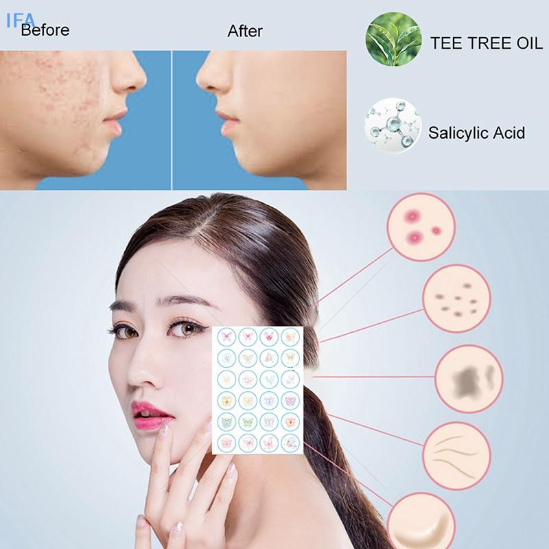 IFA 40 ชิ้นผีเสื้อที่มองไม่เห็นสิว Patch ลดสิว ckheads Mild ไม่ระคายเคืองคอนซีลเลอร์ Face Spot Skin 
