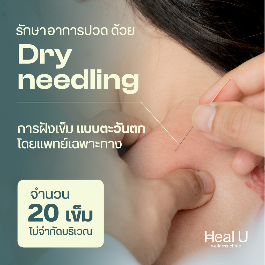 คูปอง การรักษาทางเลือก อาการปวดหลัง กล้ามเนื้อตึง  - Dry needling