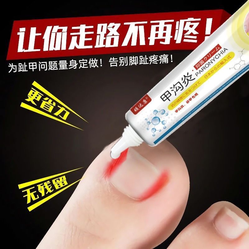 - Paronychia ครีมผูกเนื้อ Paronychia อักเสบอักเสบอักเสบบวมสีแดง Pseudo-Pseudo-