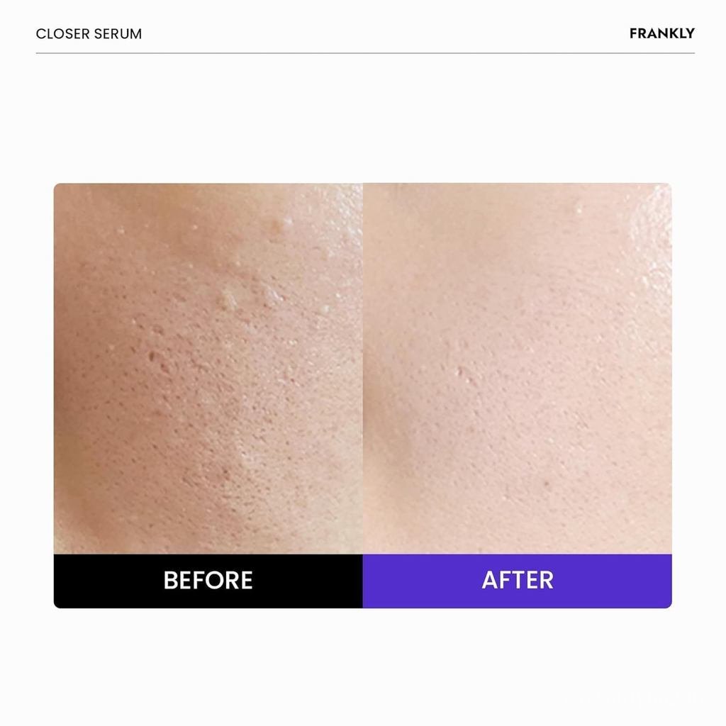 ยินดีต้อนรับFRANKLYClosverSerum|เซรั่มรูขุมขนมินิไมเซอร์|9เปปไทด์,วีแกนคอลลาเจน,อะเดโนซีน,PHA|เกาหลี