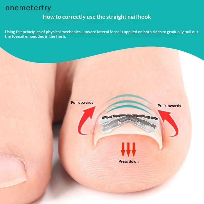 Onem 2pcs คุด Toenail Corrector Pedicure กู้คืน Embed Toe Nail Treatment Professional คุด Toenail Co