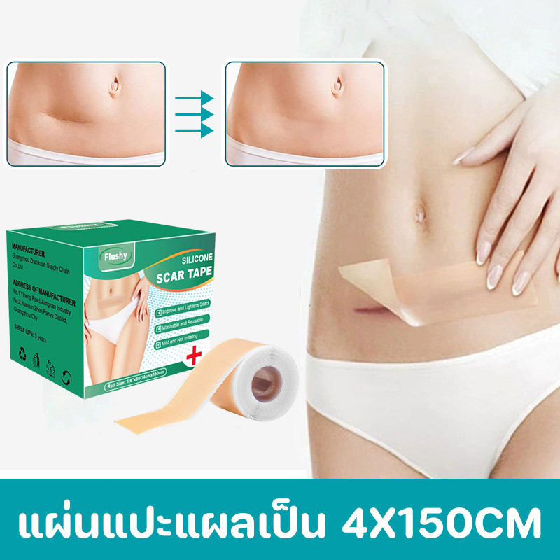 แผ่นแปะแผลเป็น ซิลิโคนรอยแผลเป็นแผ่น 1 ม้วน (4X150 ซม.)  กําจัดรอยแผลเป็นจากแผลเป็น กันน้ำ