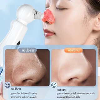 Langton ใบหน้า ทําความสะอาด เครื่องกําจัดสิวหัวดําไฟฟ้า เครื่องทําความสะอาดใบหน้า เครื่องมือดูแลผิวหน้าผิว for others