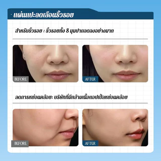 ซื้อ 1 แถม 3✨【ฟื้นฟู/กระชับผิวยามค่ำคืน】 แผ่นแปะกระชับผิวและลดริ้วรอยร่องแก้ม/กระชับผิวและลดริ้วรอย 2-in-1/แผ่นแปะบำรุงผิวล้ำลึก/เหมาะสำหรับผู้ที่มีริ้วรอยลึก