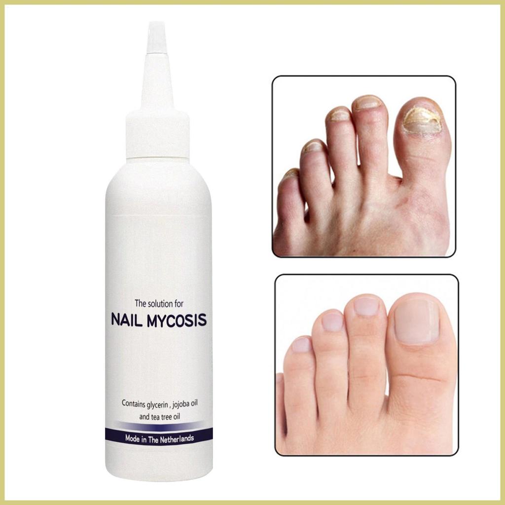 Toe Nail Repair 75ml น้ํายาซ่อมเล็บ น้ํายาบํารุงเท้าสําหรับ Salon Daily Overnight Travel Home pmuist
