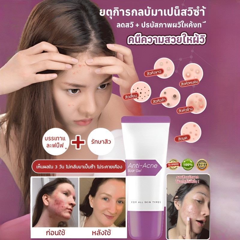 🎈ซื้อ 1 แถม 1🎈【บรรเทาและฟื้นฟู】เจลแต้มสิว/เจลซ่อมแซมรอยสิวผ่อนคลาย เจลดูแลรักษาสิวอย่างอ่อนโยน