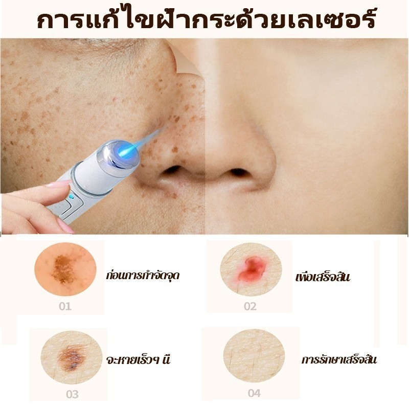 ปากกาเลเซอร์แบบพกพาปรับปรุงฝ้ากระสว่างขึ้นกระและลดจุดด่างดําและเม็ดสีได้อย่างมีประสิทธิภาพ - รูปที่ 3