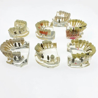 โมเดลฟันทันตกรรม Implant With Bridge & Caries Dental Study T…