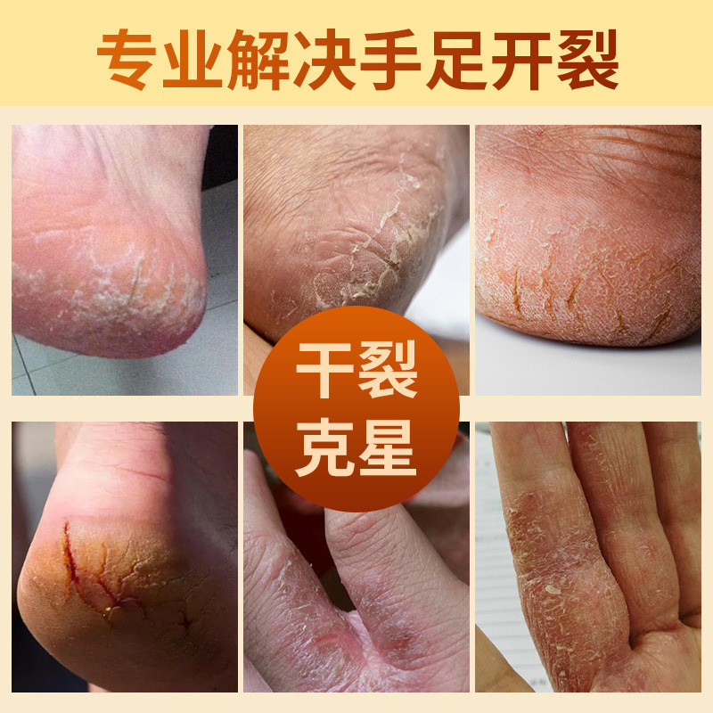 Hong Kong Big Room Snake Ointment Horse Ointment แห้ง Cracked Ointment Moisturizing Ointment Cracked