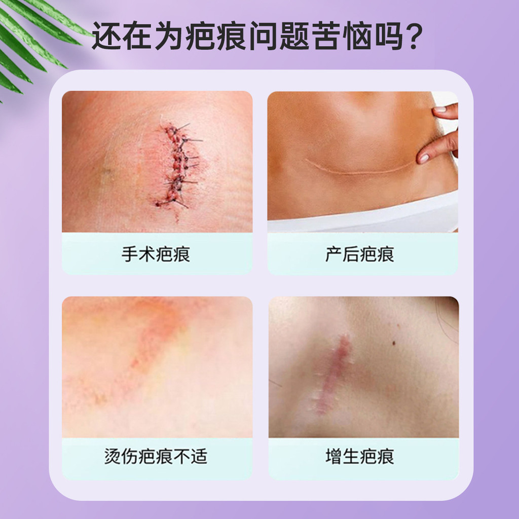 T Thailand Scar Cream ลบ Growth Scars Acne Marks One-touch Repair Cream Scar Cream ชิ้นเดียว Daigou