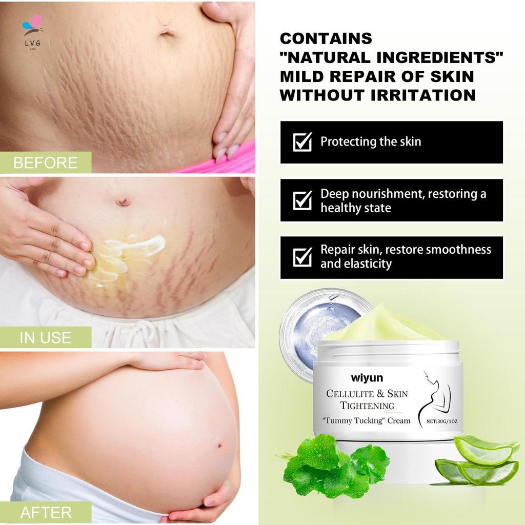Stretch Marks and Scars Removal Cream Scars Lighten & Repair Cream สําหรับระหว่างและหลังการตั้งครรภ์