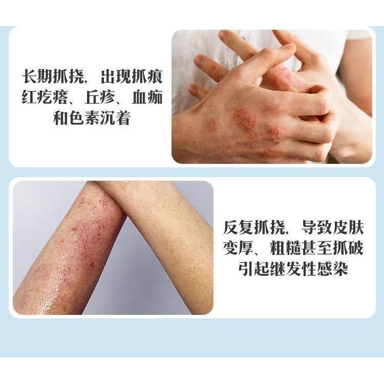 เตา Sweet Stone Health Cream Anti-Itch ทั้ง Body Dry Itch เทคนิคพิเศษภายนอกครีมเตาหวานของแท้ยี่ห้อ A