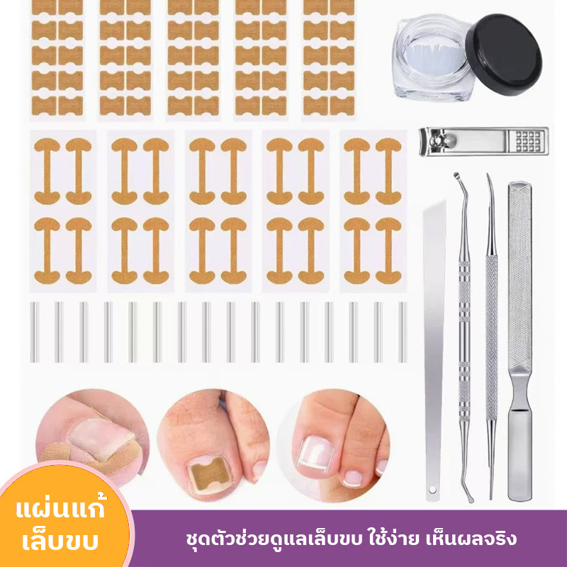อุปกรณ์แก้ไขเล็บขบ แก้ไขร่องเล็บ ที่ตัดเล็บเท้า