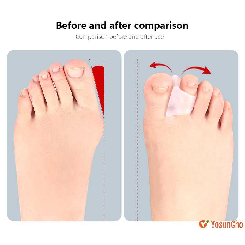YosunChoker] 2 ชิ้นค้อน Toe Straightener Hammertoe Corrector สําหรับ Curled Crooked Bent และ Claw To