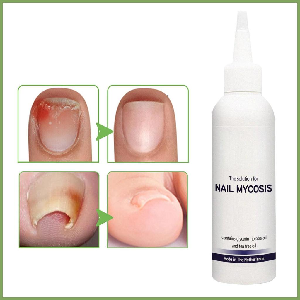 Strengthener 75ml Nail Care Solution น้ํายาบํารุงเท้าสําหรับ Salon Daily Overnight Travel Home Pedic