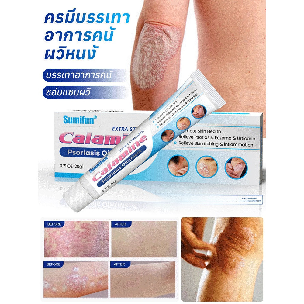 【เห็นผลเร็ว สูตรอ่อนโยน】ครีมรักษาโรคสะเก็ดเงินและผิวหนังอักเสบ JC ครีมลดคัน/รักษาสะเก็ดเงิน/ผิวหนังอักเสบ/สูตรอ่อนโยน/ดูแลผิวแพ้ง่าย