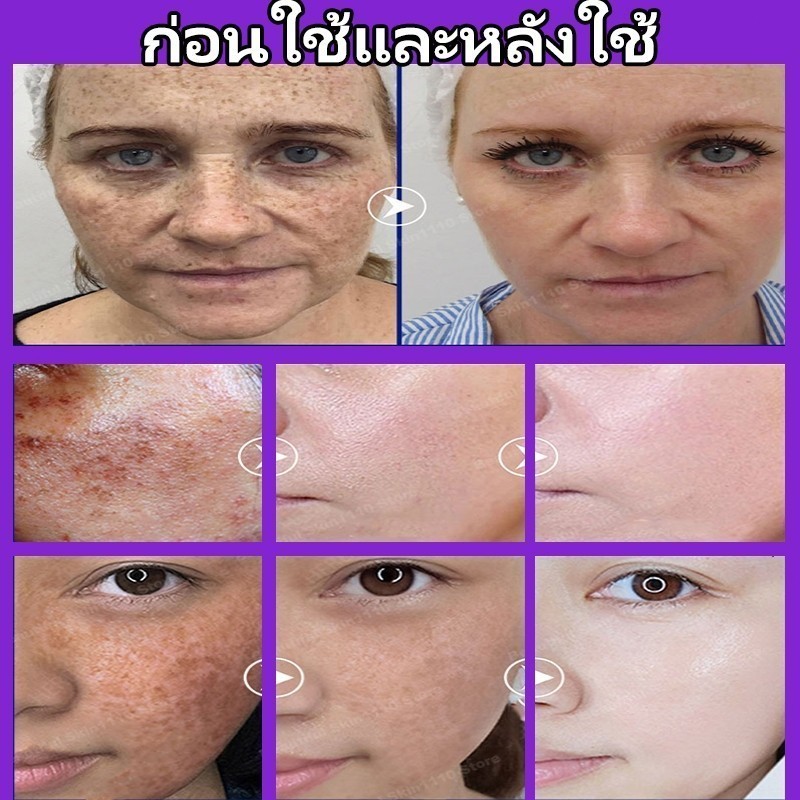 ปากกาเลเซอร์แบบพกพาปรับปรุงฝ้ากระสว่างขึ้นกระและลดจุดด่างดําและเม็ดสีได้อย่างมีประสิทธิภาพ - รูปที่ 2