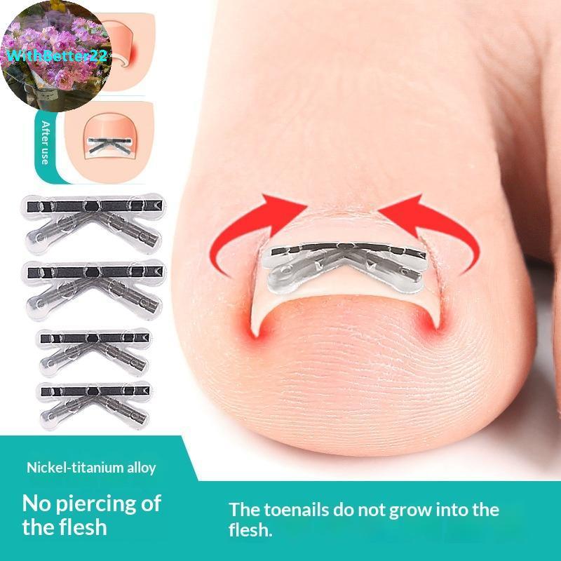 ด้วยดีกว่า 2 ชิ้นคุด Toenail Corrector Pedicure กู้คืน Embed Toe Nail Treatment Professional คุด Toe