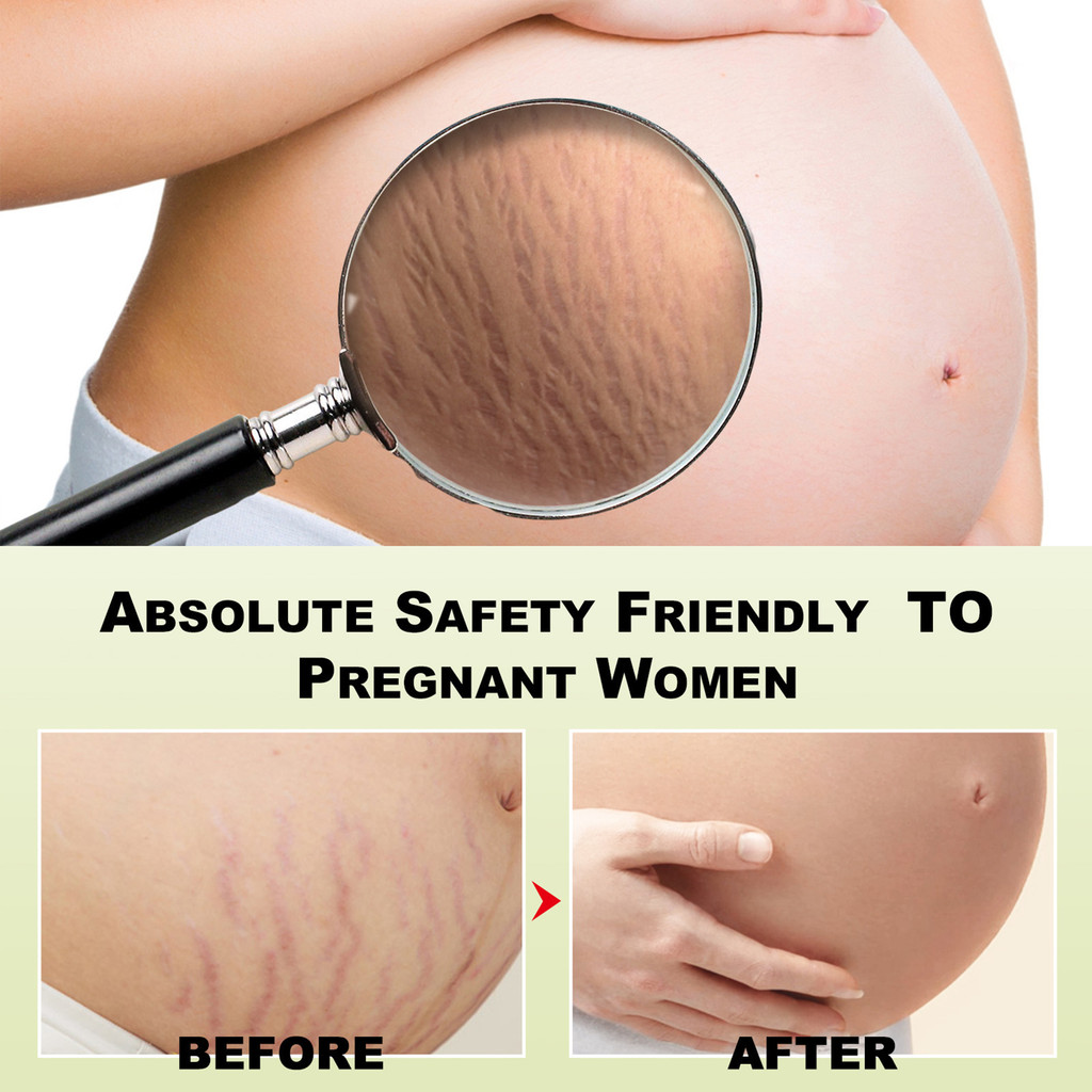 Stretch Marks and Scars Removal Cream Scars Lighten & Repair Cream สําหรับระหว่างและหลังการตั้งครรภ์