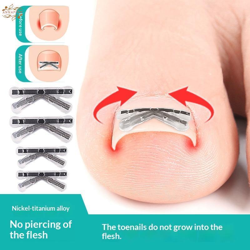 Ank 2 ชิ้นคุด Toenail Corrector Pedicure กู้คืน Embed Toe Nail Treatment Professional คุด Toenail Co
