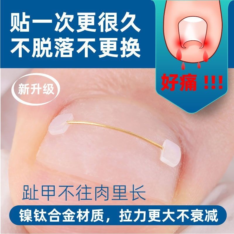 hot🔥การประกันคุณภาพ🔥 Dr. Qu Ping's Nail Groove Ingrown Nail Nickel Titanium Alloy Wire Memory Wir