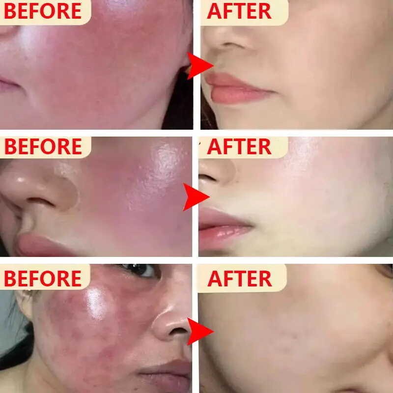 Rosacea บรรเทาแห้งไวคันผิวซ่อมแซมอุปสรรคความชุ่มชื้นโลชั่นเครื่องสำอางเกาหลี ครีมซ่อมแซมผื่นแดงหน้าใ