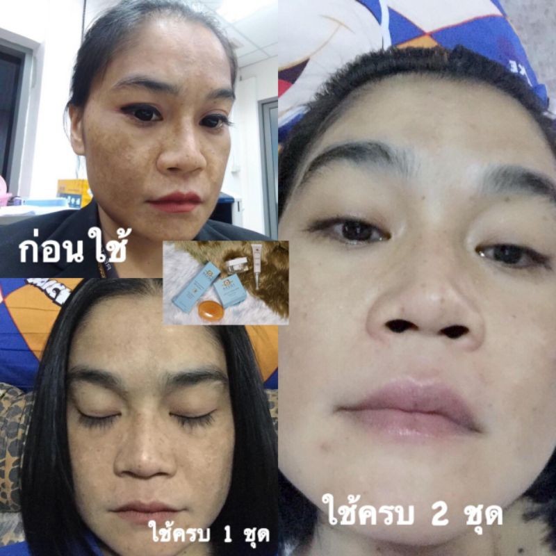 :: M 5 :: ครีมมาส์ก(ครีมฝ้า) 5 กระปุก 2,799฿