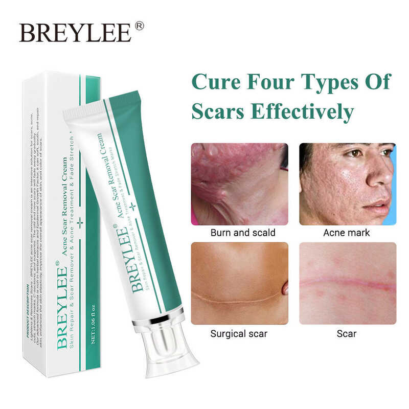 Stock】Breylee Ko【Ready Acne Repair Cream Fading Stretch Marks Scar Remover 30G