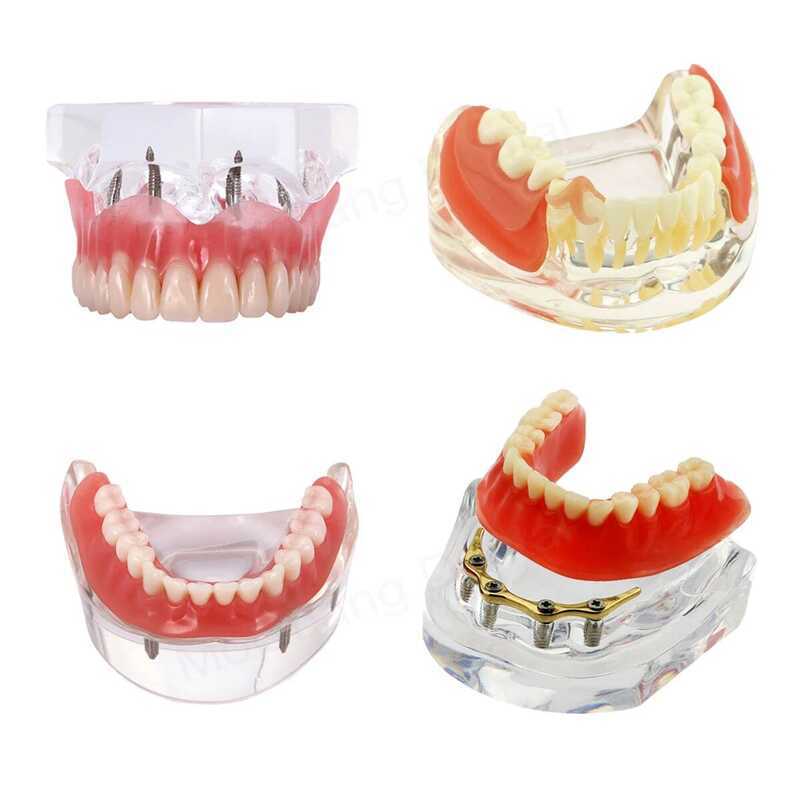 C Denta Mode With Removabe And Restorabe Teeth Denta Eduion Mode Impant Overdenture Teeth For Resei