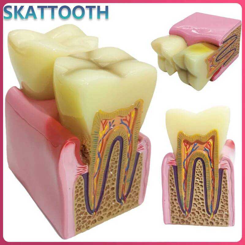 C 8 Times Dental Model Caries Disease Periodontitis Case Analysis Teeth Model For Dental Demonstrat
