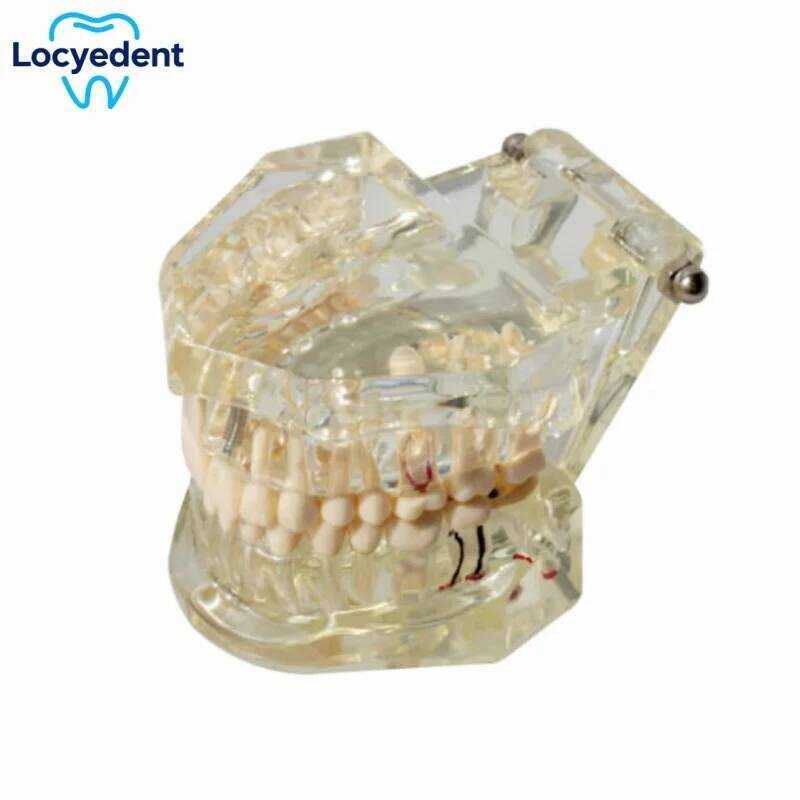 C Dental Ching Model Repairable Resin Models Diseased Teeth Rese Medicine Diseases Ching Study