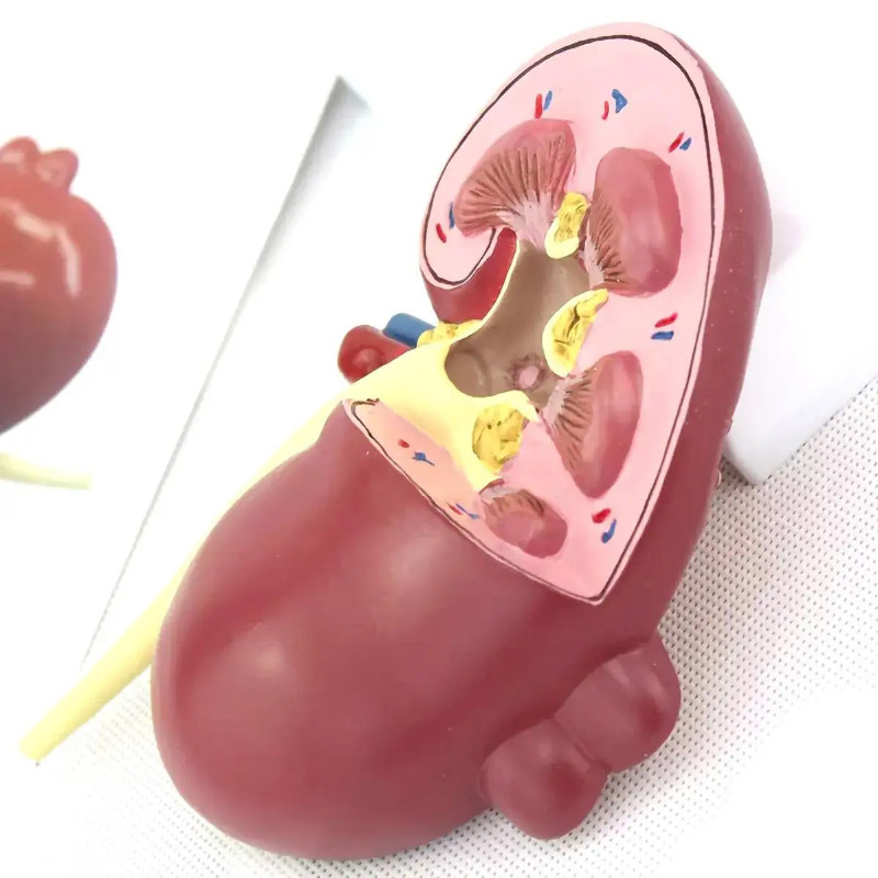 Human Pathological kidney Tumors Model Medical Teaching Models