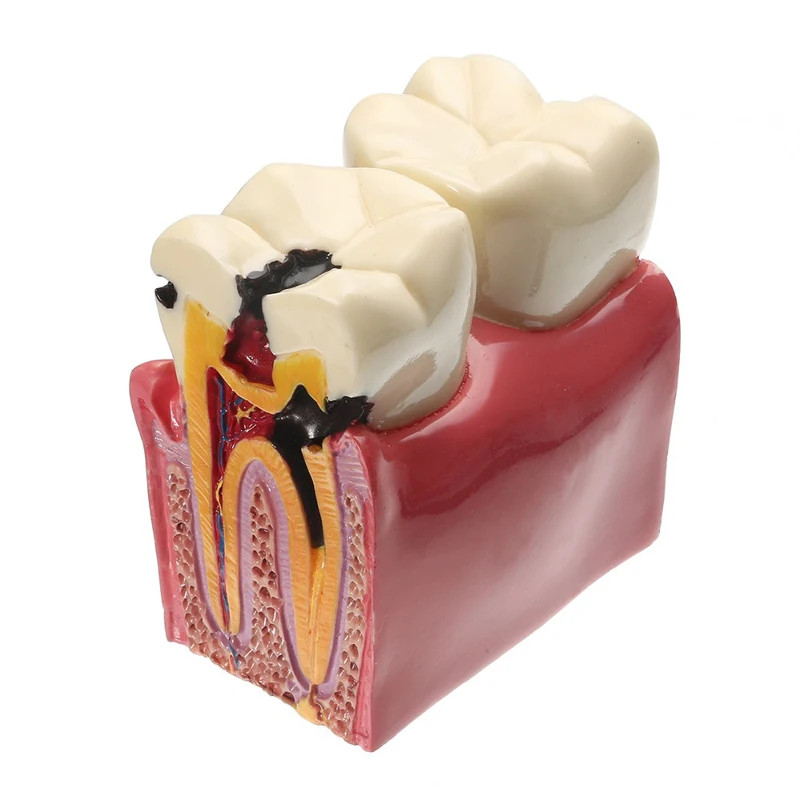 6 Times Magnification of Dental Caries Oral Model Medical Teaching Tools Drop Shipping