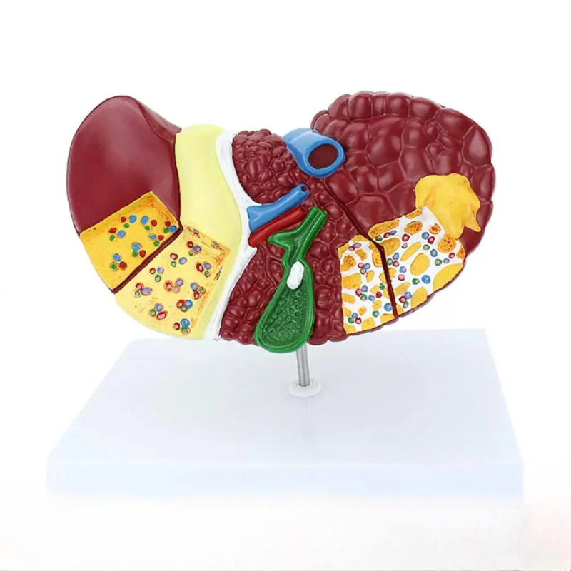 PVC Human Cirrhosis Biliary Obstruction Gallstones And Tumors Model Medical Teaching Models